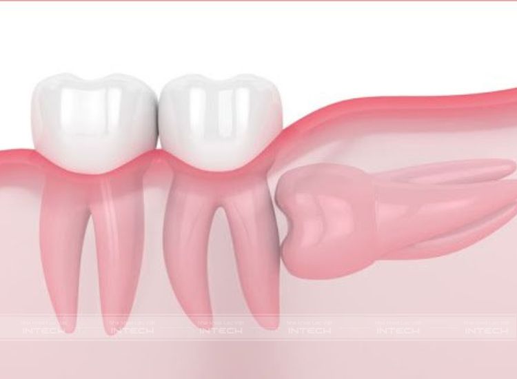 Răng số 8 mọc ngầm có xu hướng đâm vào răng 7