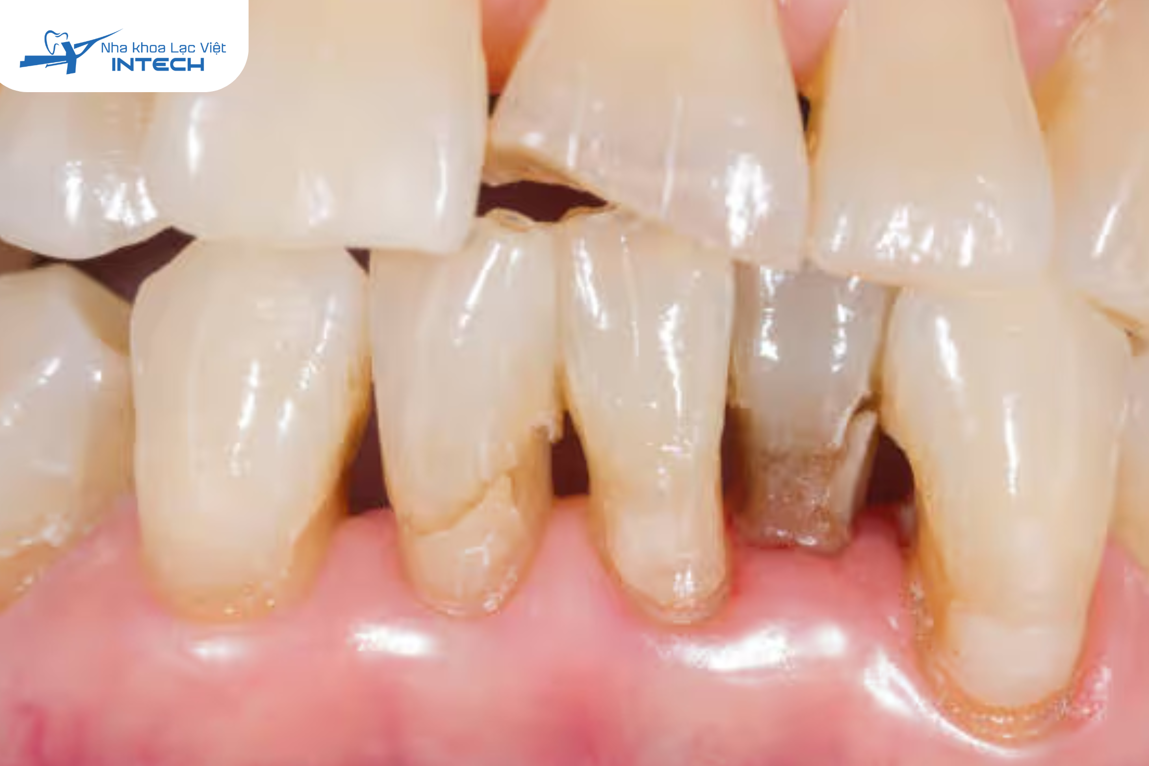 Răng hàm lung lay mức độ 2