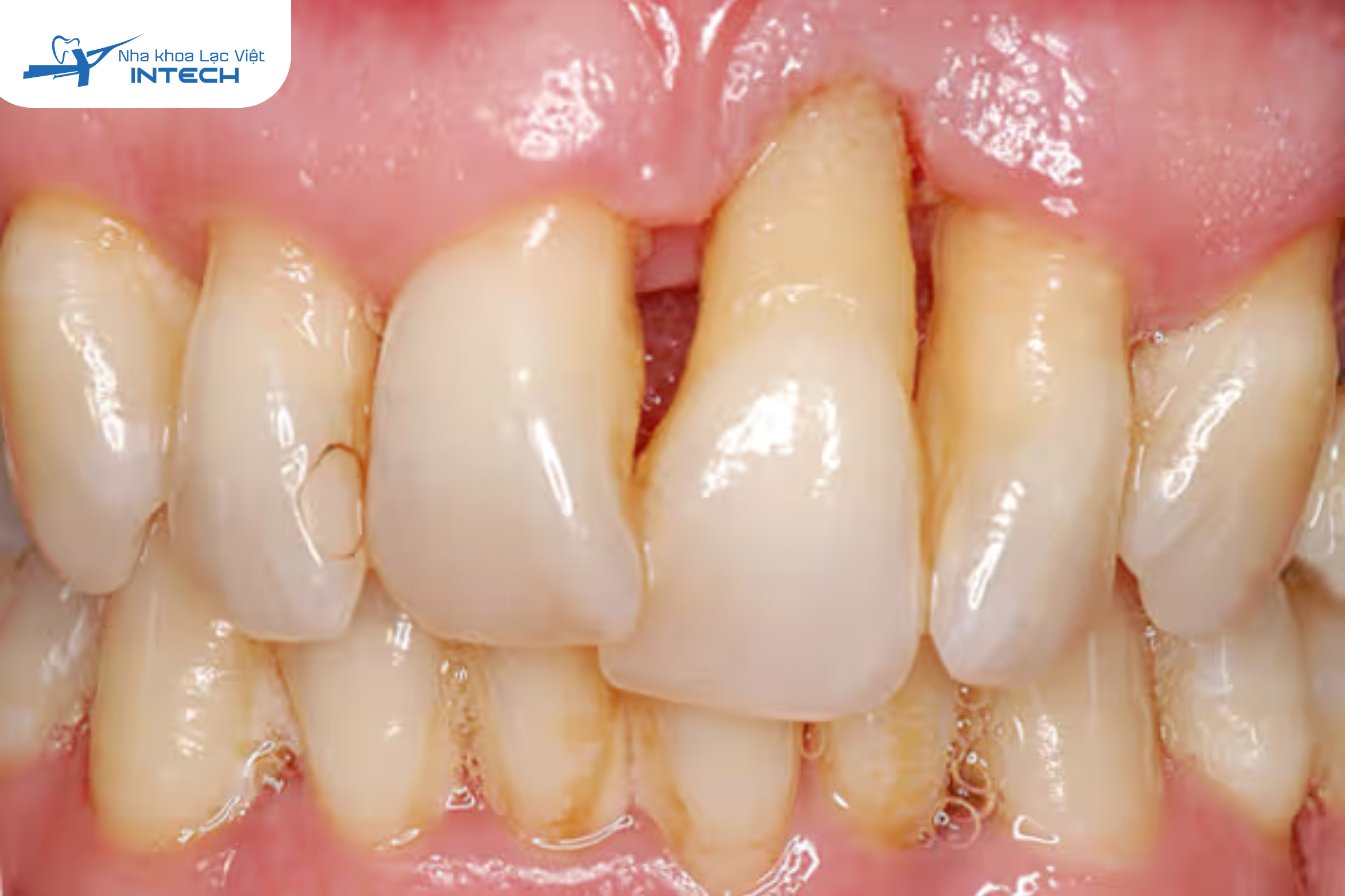 Răng lung lay-dấu hiệu niềng răng hỏng 