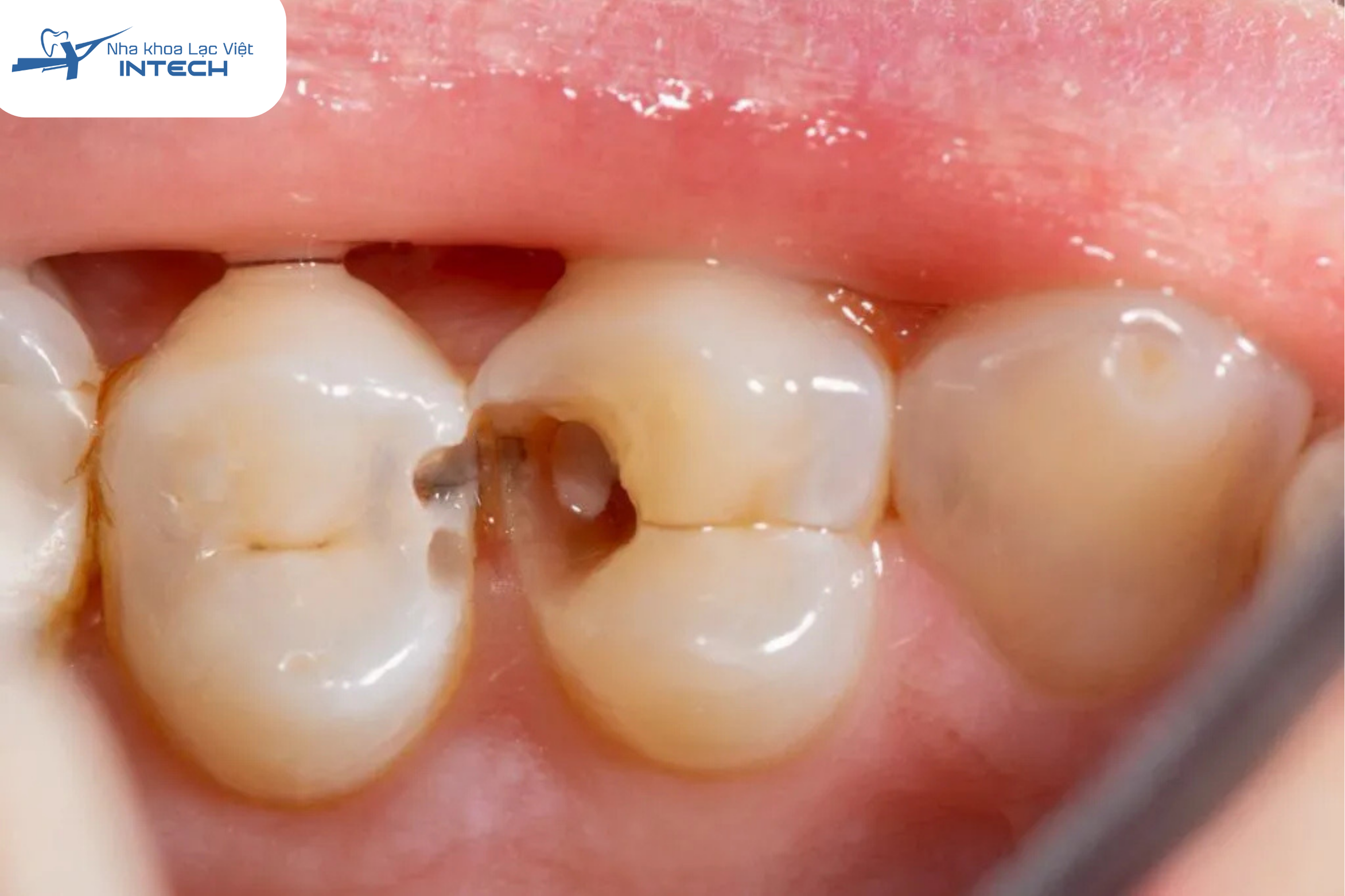 Răng sâu nhẹ, lỗ nhỏ chưa cần bọc sứ ngay