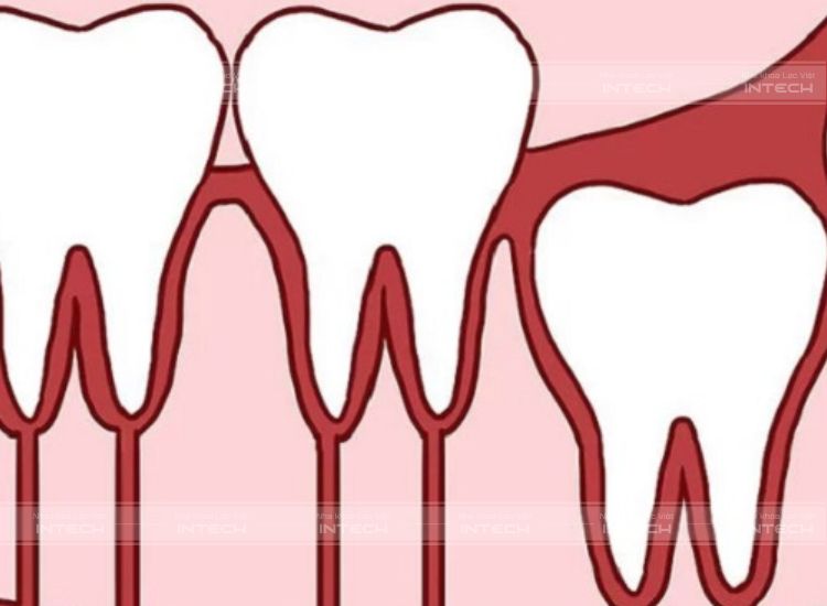 Răng số 8 mọc thẳng