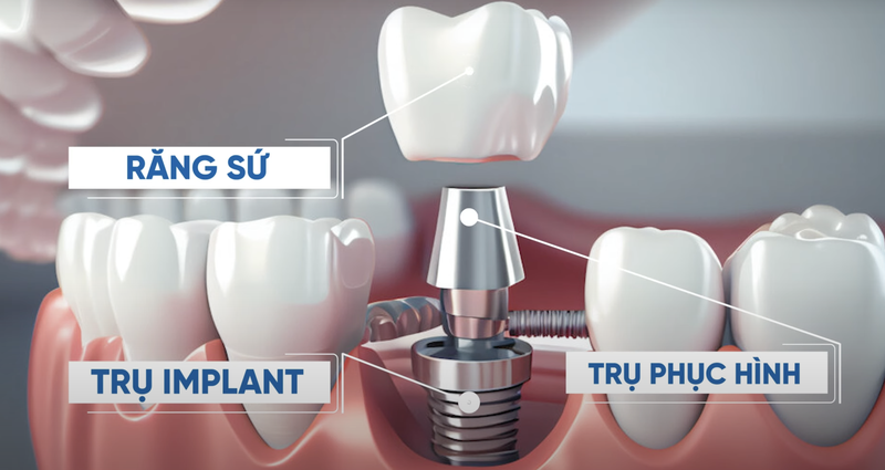 Mão răng sứ thay thế phần men răng trên răng thật, giúp cải thiện thẩm mỹ và chức năng ăn nhai