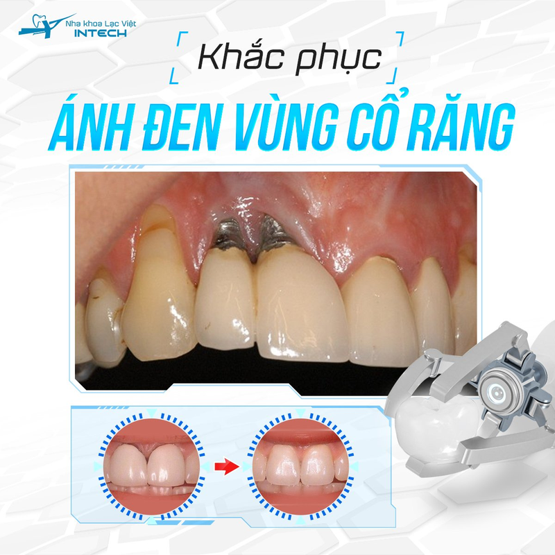 Răng toàn sứ nguyên khối có tính thẩm mỹ cao, ngăn chặn hiện tượng ánh đen chân răng mất tự nhiên