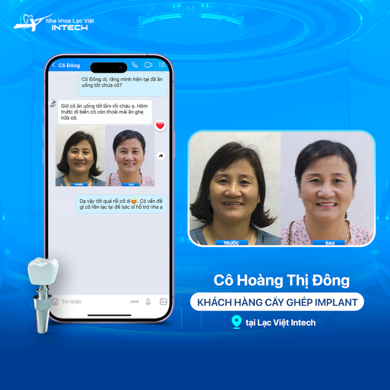 Răng Implant khôi phục khả năng ăn nhai gần như răng thật, có thể ăn nhai các loại thực phẩm cứng, giòn vừa phải