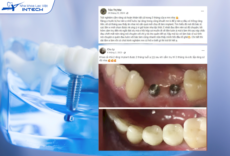 Thời gian tích hợp trụ Implant với xương hàm thường từ 1 đến 2 tháng