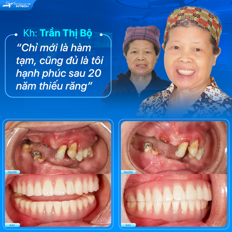Trồng răng Implant còn giúp cải thiện tình trạng xô lệch răng, răng sâu kém thẩm mỹ