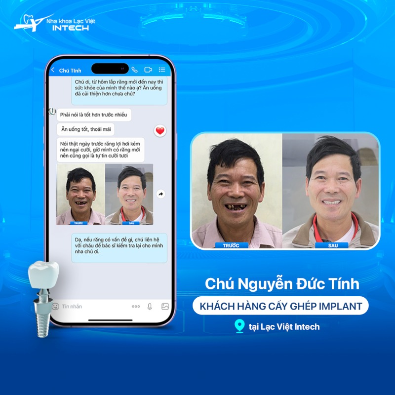[Review trồng răng Implant] Bóc trần 7+ sự thật về răng Implant