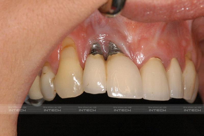 Những rủi ro khi cấy ghép Implant