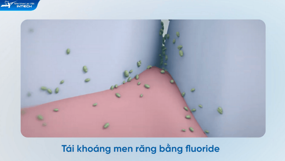 Sâu răng trước khi niềng