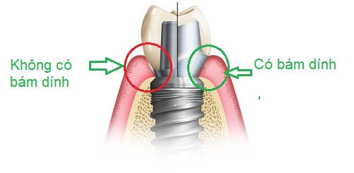trồng răng implant cá nhân hóa