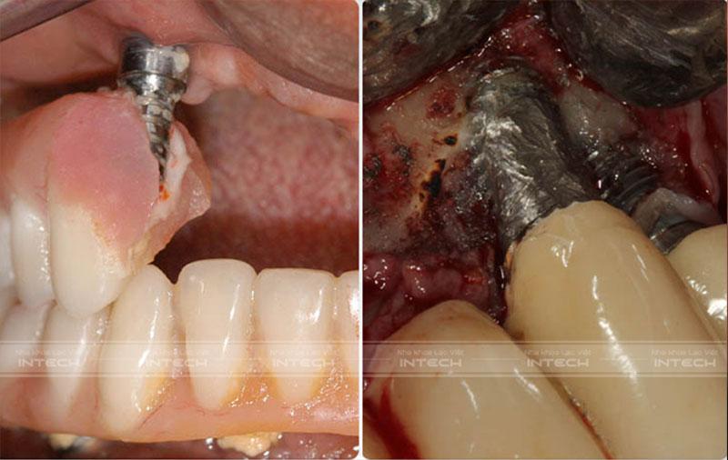 Sử dụng Implant kém chất lượng gây đào thải ngay sau khi cấy ghép
