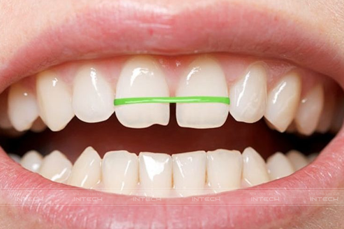 Sử dụng thun buộc để niềng răng