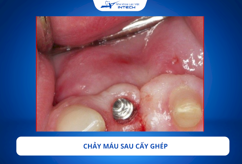 Cô chú/anh chị có thể gặp tình trạng chảy máu nhẹ sau cấy ghép, khiến nước bọt có màu hồng