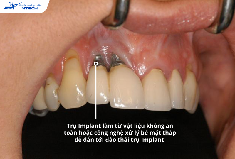 Trồng Implant tại các nha khoa kém uy tín có thể kéo dài thời gian điều trị bởi nguy cơ xuất hiện các biến chứng