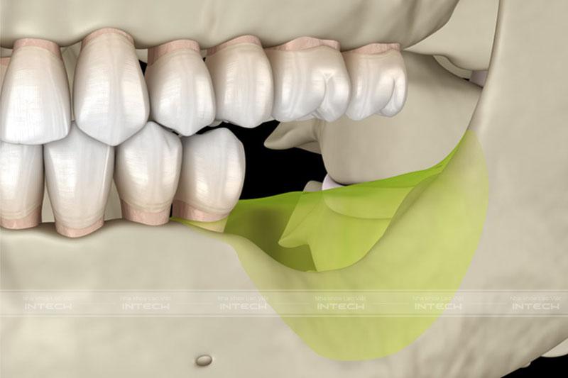 Tình trạng tiêu xương hàm