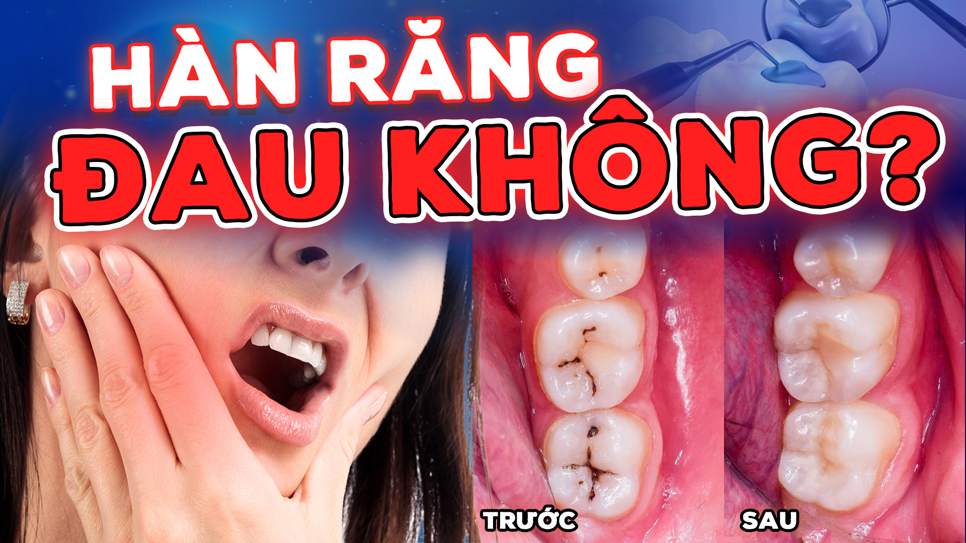 Hàn răng là gì? Hàn răng có đau không? Quy trình như thế nào?