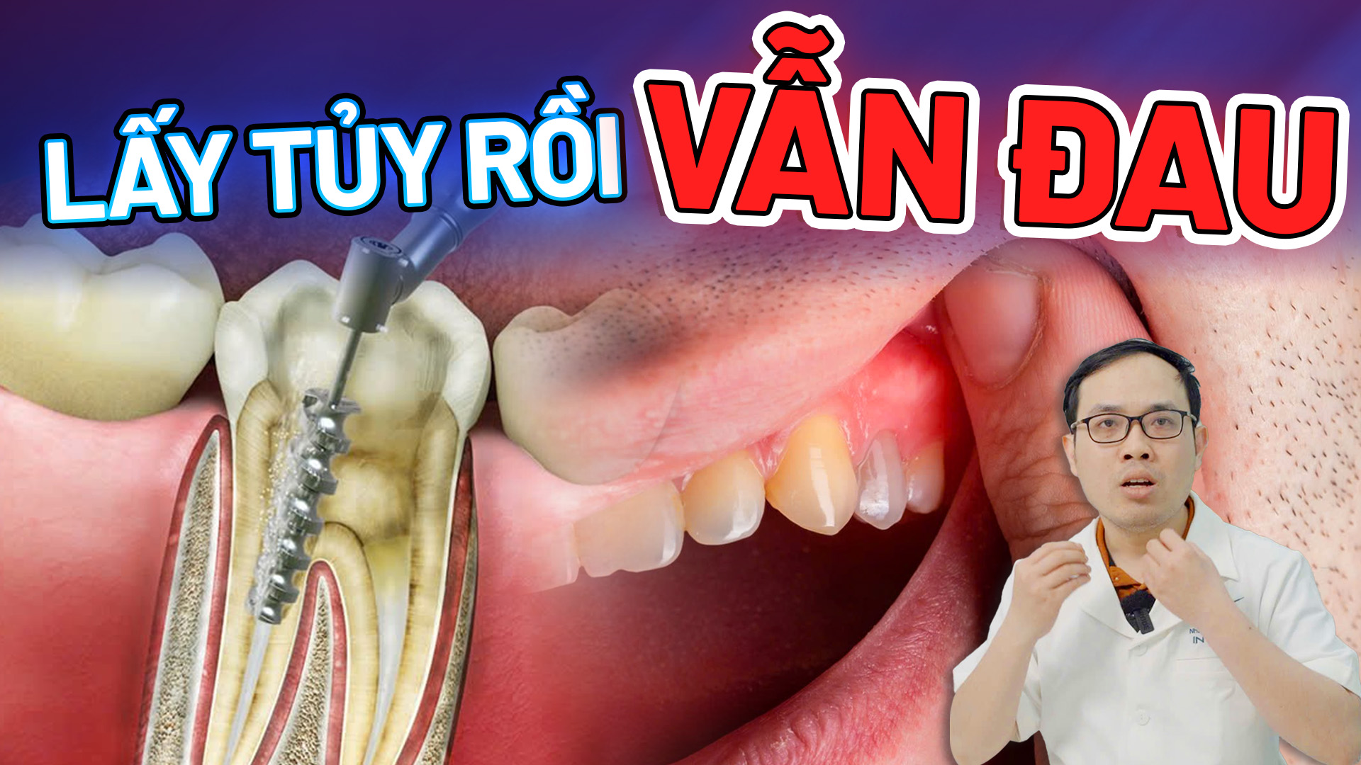 Răng lấy tuỷ vẫn đau: Nguyên nhân và cách khắc phục