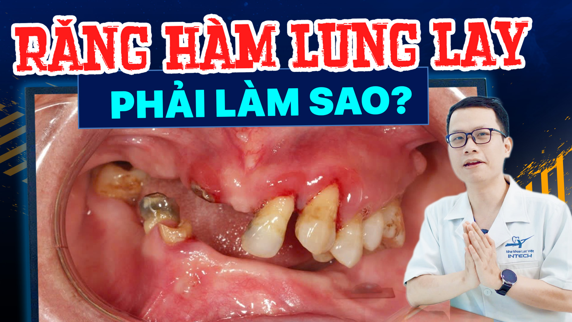 Răng hàm lung lay phải làm sao? 4 cách phòng ngừa hiệu quả nhất