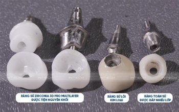 Tại sao răng sứ Zirconia 3D Pro Multilayer hiệu quả trong phục hình implant?