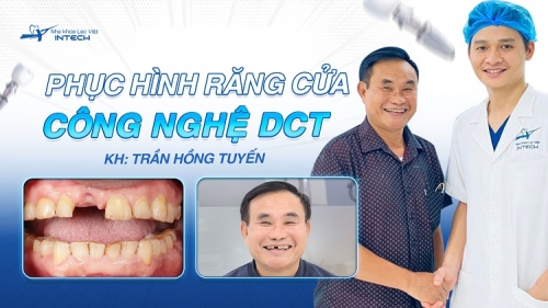 "RĂNG IMPLANT ĐẸP HƠN CẢ RĂNG THẬT, MỌI NGƯỜI ĐỀU KHÔNG BIẾT LÀ TÔI TRỒNG IMPLANT"