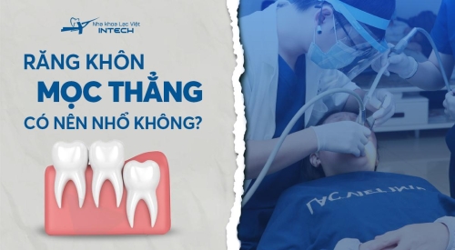 Răng khôn mọc thẳng có nên nhổ không? Giải đáp từ chuyên gia