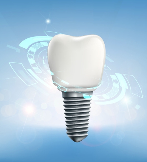 Trồng răng Implant