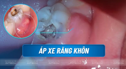 Áp xe răng khôn: Biến chứng nguy hiểm và cách xử lý hiệu quả