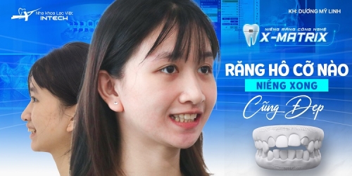 Thanh xuân đẹp hơn kể từ khi bắt đầu niềng răng!