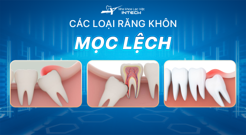 Các dạng răng khôn mọc lệch phổ biến và cách điều trị hiệu quả
