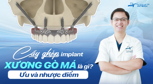 Cấy ghép Implant xương gò má 