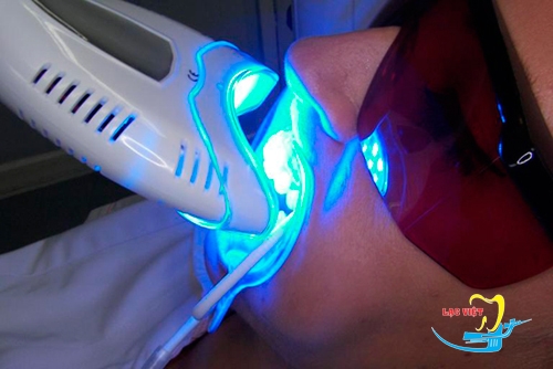 Có nên tẩy trắng răng bằng đèn Plasma- Chuyên gia nha khoa giải đáp