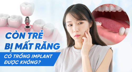 Còn trẻ mất răng trồng Implant được không? Ảnh hưởng mất răng ở trẻ?