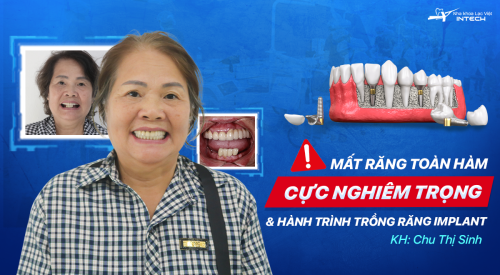 Tiêu xương nghiêm trọng vì sử dụng hàm tháo lắp 10 năm