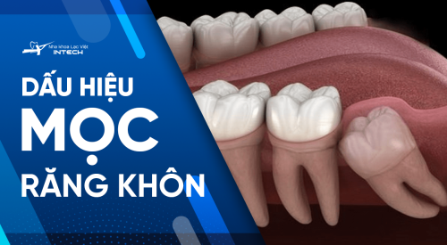 6 dấu hiệu mọc răng khôn mà bạn không nên chủ quan