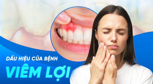 Dấu hiệu viêm lợi? Viêm lợi để lại biến chứng gì? Điều trị thế nào?