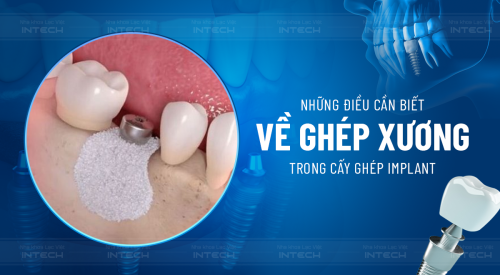 ghép xương trong cấy ghép implant
