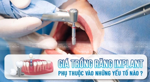 Giá trồng răng implant phụ thuộc vào yếu tố nào?