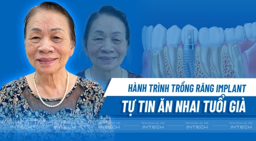 Hành trình phẫu thuật cắm Implant All On 4 an toàn, không đau cô Minh Phương