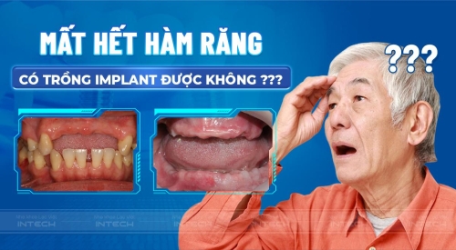 Mất hết hàm răng trồng Implant được không? Ảnh hưởng mất răng toàn hàm?