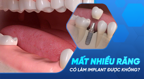 Mất nhiều răng làm Implant được không