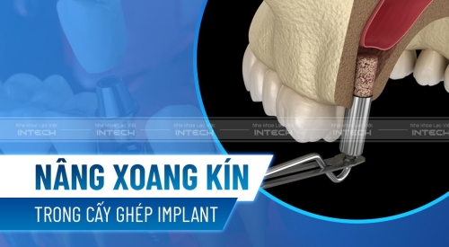 Kỹ thuật nâng xoang kín trong cấy ghép Implant diễn ra như thế nào? Đau hay không?