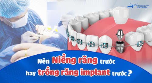 Nên niềng răng trước hay trồng răng implant trước? Chuyên gia giải đáp