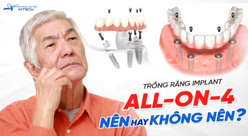 Nên cấy ghép implant toàn hàm all on 4 không? Chuyên gia giải đáp chi tiết