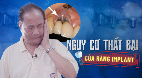 Tìm hiểu nguy cơ thất bại cấy ghép Implant - BS chia sẻ trực tiếp