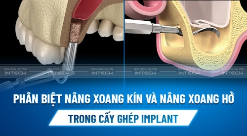 Phân biệt nâng xoang kín và nâng xoang hở trong cấy ghép implant