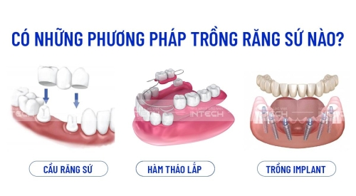 trồng răng sứ