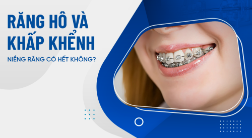 Răng hô và khấp khểnh niềng răng có hết không?