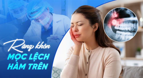 Mọc răng khôn phải kiêng gì?
