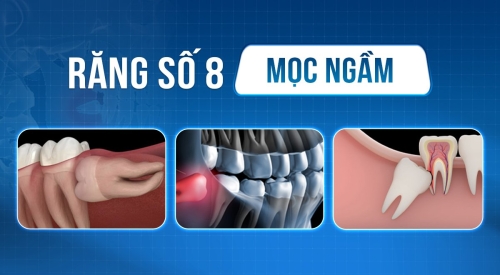 Răng khôn mọc ngầm là gì? Có đau không? Biến chứng là gì?