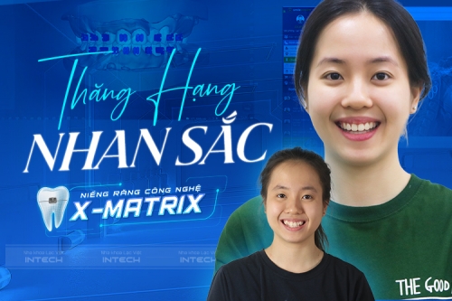 Trước và sau khi niềng - Sự khác biệt khó tin của 9X răng chen chúc khấp khểnh